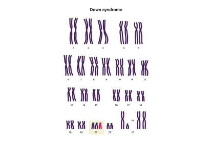 Trisomía en el cromosoma 21. Fuente: Rujirat Boonyong