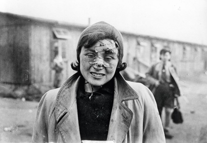 Prisionera del campo Bergen-Belsen herida en el rostro